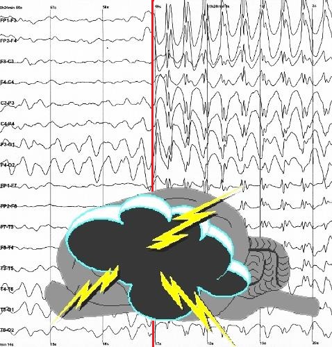Epilepsia_2obr.jpg